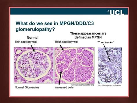 Rapidly Progressive Glomerulonephritis Ppt