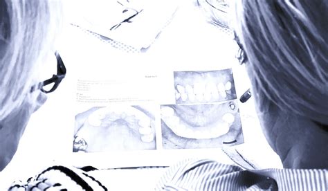 Clear Aligner Treatment Planning Service Or Treatment Planning Support