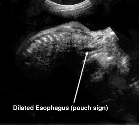 Tracheoesophageal Fistula Ultrasound