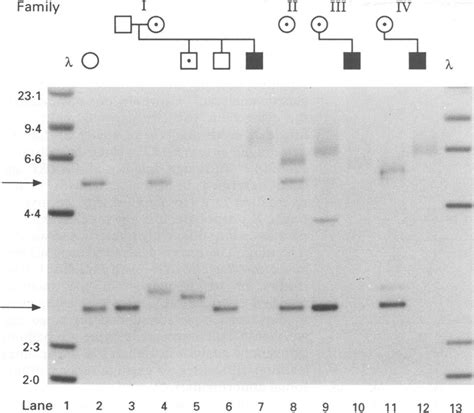 Figure Southern Blot Analysis Forfragile X Syndrome In Families I Iv