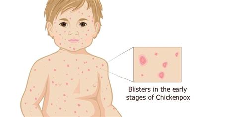 Stages Of Chickenpox