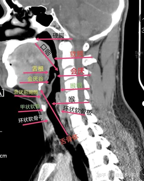 喉的ct解剖 知乎