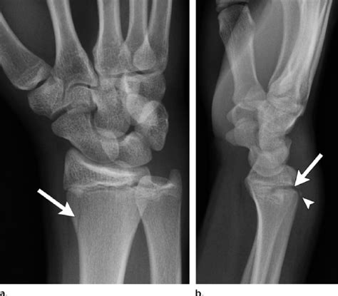 Salter Harris Type Ii Fracture In A Year Old Boy A Slightly