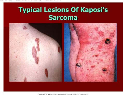 Figure 1 From Kaposi Sarcoma Clinical Indices And Diagnosis Semantic