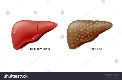 Comparison Healthy Liver Cirrhosis Liver Disease Vector De Stock