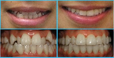 The Size and Shape of Your Teeth - Manhattan Bridge Orthodontics