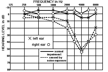 Audiogram