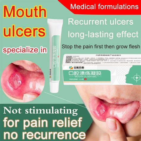 Oral Ulcer Mouth Ulcer Gel Oral Care G Canker Sore Treatment