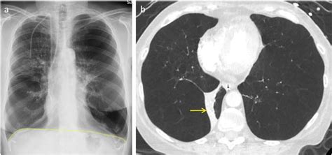 Imaging Of Emphysema A Comprehensive Review Intechopen