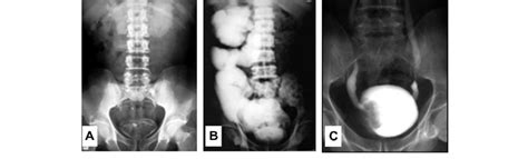 Radiographic Appearances In Advanced Urinary Schistosomiasis A