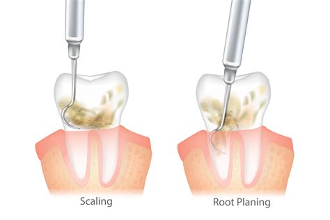 Periodontal Scaling And Root Planning In San Jose Ca