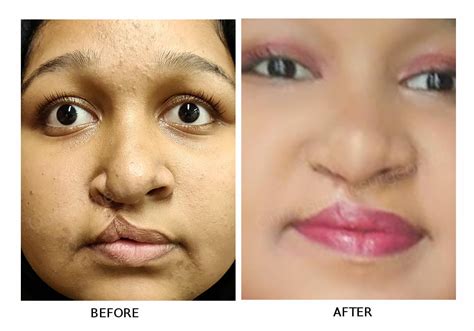 Cleft Lip Surgery Before And After