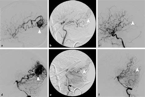 Intraoperative Imaging For Arteriovenous Malformations And Dural Arteriovenous Fistulas Neupsy Key