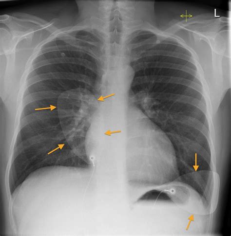 Defibrillation Pads CXR Radiology At St Vincent S University Hospital