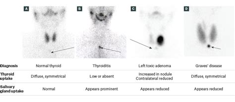 Racgp Thyroid Disease Using Diagnostic Tools Effectively