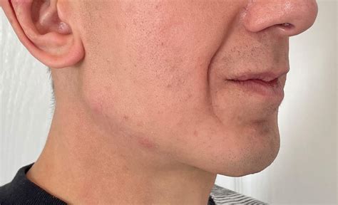 Plastic Surgery Case Study Custom Jawline Implant Replacement For