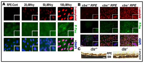 Hcy Induces Accumulation Of β Amyloid And P Tau Proteins In Retinal