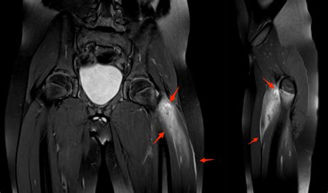 Vastus Lateralis Injury Coachingultrasound