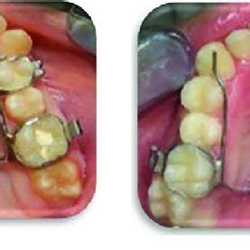 (a) Quad helix maxillary expander used in the study; (b) Hyrax... | Download Scientific Diagram