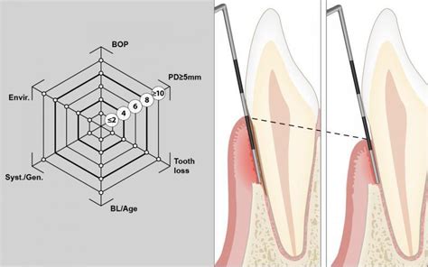 Perio Tools Su Portal En L Nea Para Herramientas Periodontales