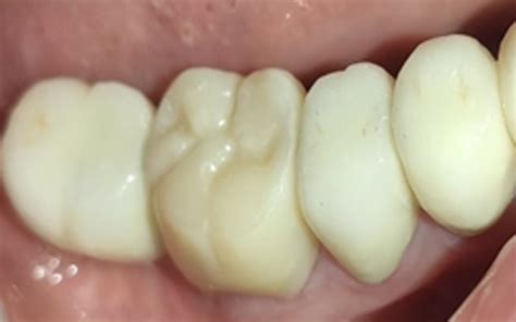 Metal Free Zirconia Crown V S Porcelain Fused To Metal Crown Dr