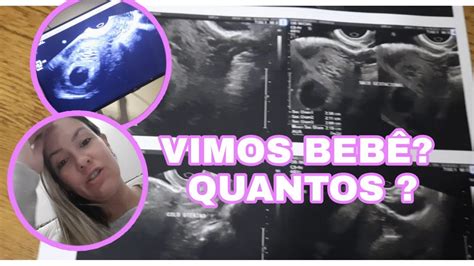 Segunda Ultrason Vimos O Beb Emocionante Primeira Ultra Ap S Saco