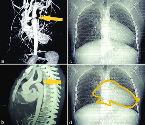 A And B Computed Tomography Aortogram Of Case 1 Demonstrating Aortic Download Scientific