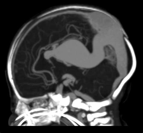 Vein of Galen Malformation - radRounds Radiology Network