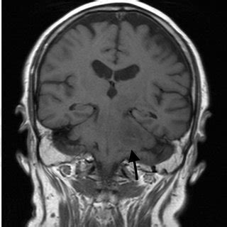 Brain MRI Coronal T1 Weighted Sequence Showing That The Lesion