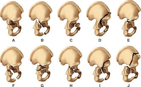 Fractures of the Acetabulum | Musculoskeletal Key