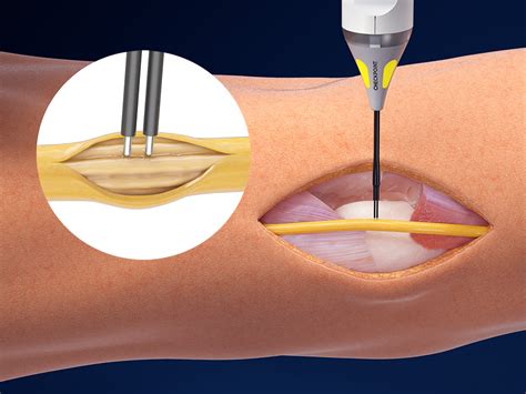 Checkpoint Gemini Checkpoint Surgical