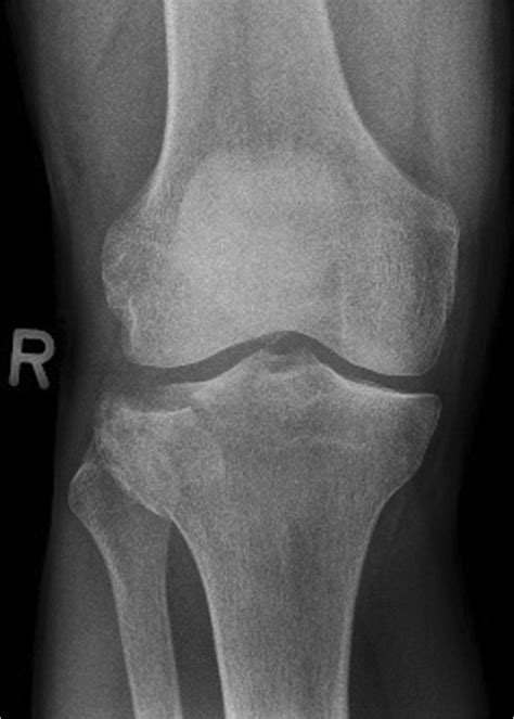 Anteroposterior A P X Ray Of The Knee Showing An Ao 41 B31 Fracture Download Scientific