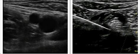 Nerve Stimulator Versus Ultrasound Guided Femoral Nerve Block A Randomized Clinical Trial