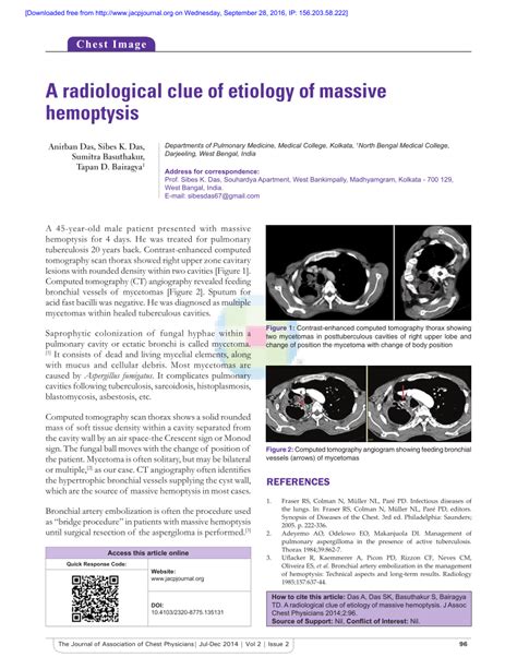 (PDF) A radiological clue of etiology of massive hemoptysis