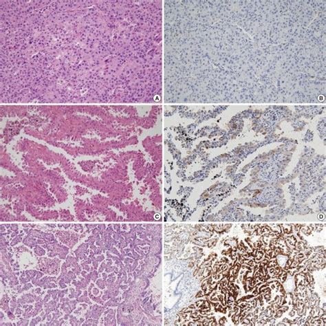 Predominant Histologic Pattern According To Nkd Ex Pression