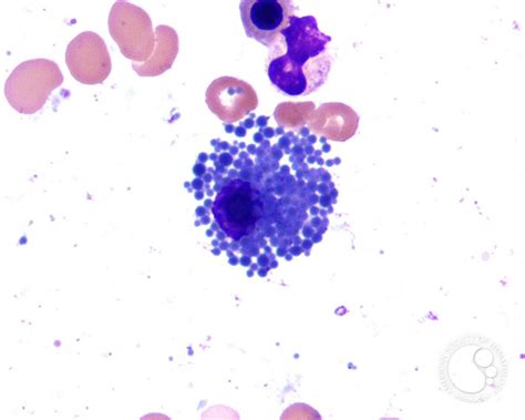 Plasma Cell Inclusions 2