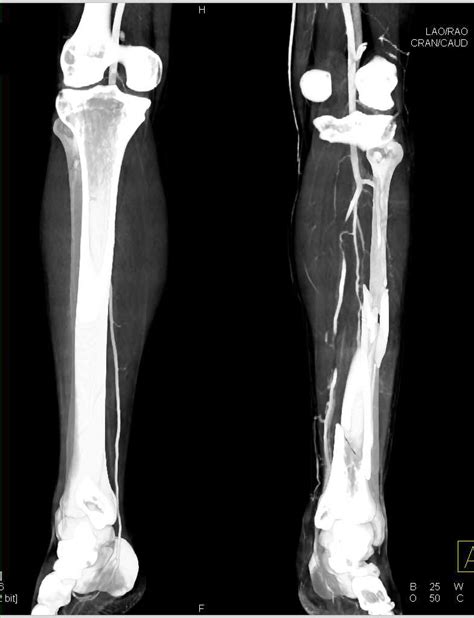 Spiral Fracture Tibia