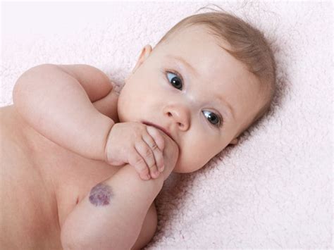 New AAP Guideline Available for Infantile Hemangioma Treatment ...