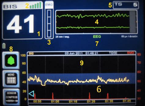 Uso Del índice Biespectral Bis En Uci Cuidados De Enfermería