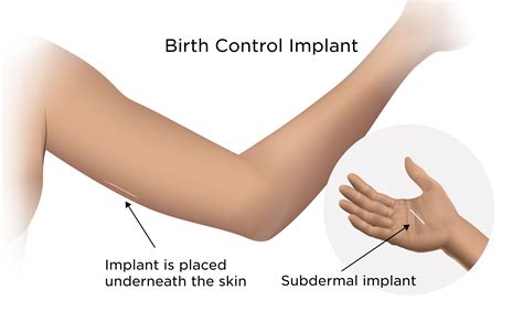 The Birth Control Implant My Doctor Online