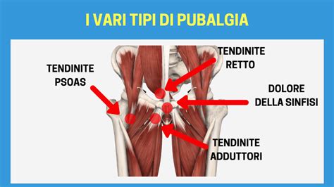 Curare La Pubalgia In 3 Step Esercizi E Rimedi Che Funzionano