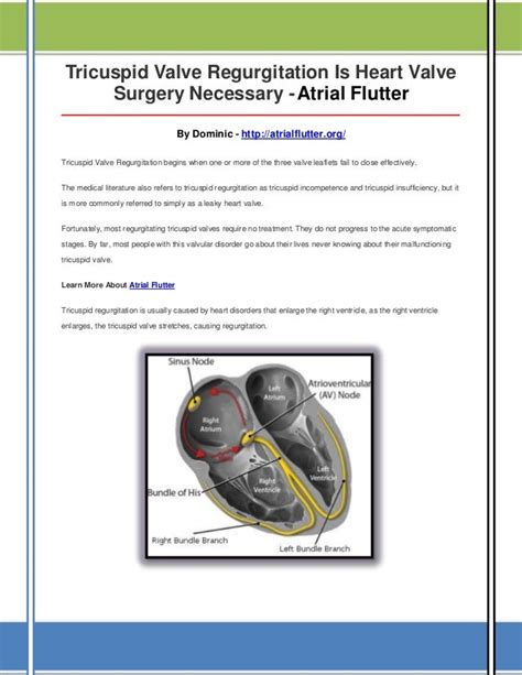 Tricuspid valve regurgitation is heart valve surgery necessary