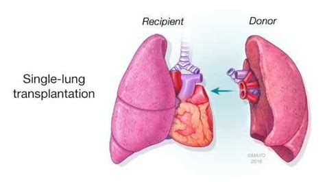 Mayo Clinic In Arizona Opens Lung Transplant Program Lung Transplant