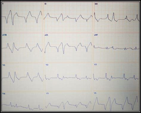 Accelerated idioventricular rhythm with short-coupling beats ...