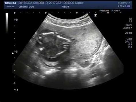 ultrasound video showing intra uterine death   fetus