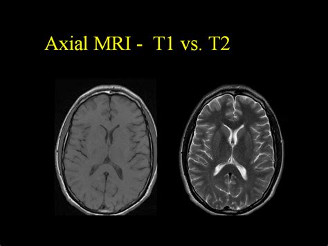 Education. The only thing that is black and white in MS is your MRI ...