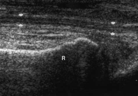 Sonography And MR Imaging Of Bifid Median Nerve With Anatomic And