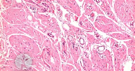 Primary Cutaneous Amyloidosis Pathology Image