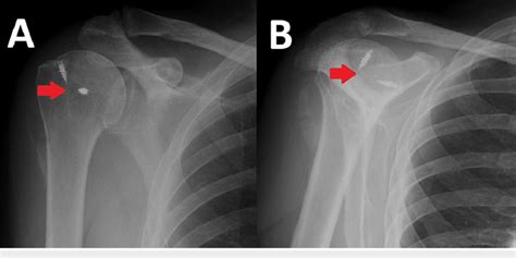 Postoperative Radiographs Arrows Indicate In Situ Bone Anchors In The Download Scientific