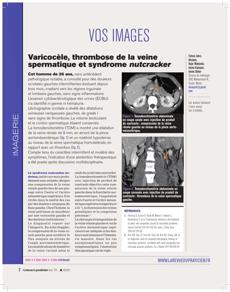 Pdf Varicoc Le Thrombose De La Veine Spermatique Et Syndrome Nutcracker